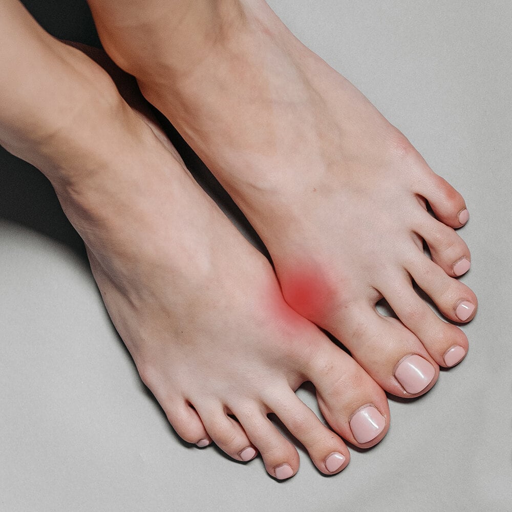 https://www.myfeet.no/pub_docs/files/404content/hallux-valgus.jpg