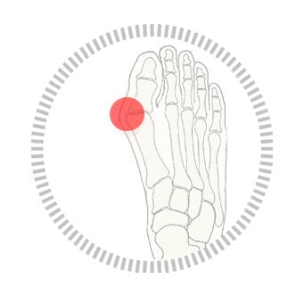 https://www.myfeet.no/pub_docs/files/HurblirmanavmedHalluxValgus/hallux-valgus.jpg