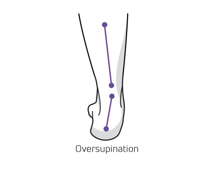 https://www.myfeet.no/pub_docs/files/Hurvetjagomjagpronerarellersupinerar/overdriven-supination.jpg