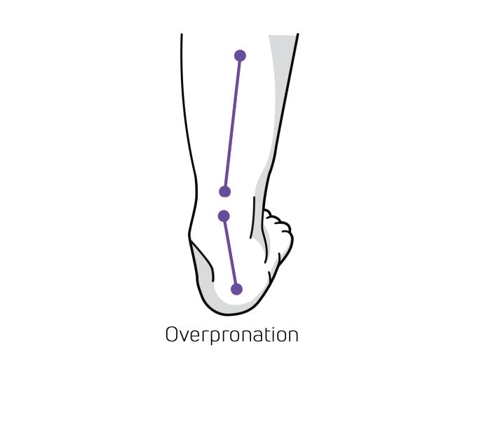 https://www.myfeet.no/pub_docs/files/Hurvetjagomjagpronerarellersupinerar/overpronation.jpg